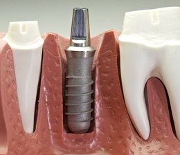 Model of a single unit dental implant post.