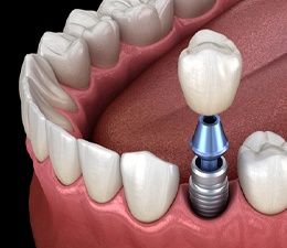 Model showing each part of a single dental implant.