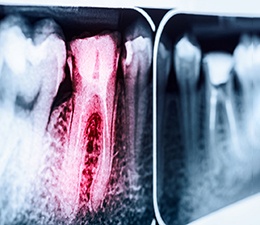 an X-ray of root canals in Waterbury