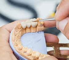 Hands customizing dental bridge on model teeth