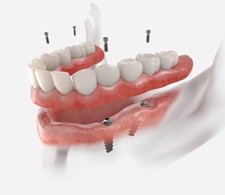 Illustration of lower implant denture being placed