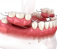 Partial denture