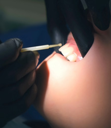Dentist putting fluoride on a child’s teeth 