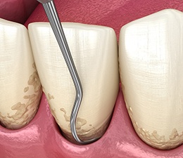 A 3D illustration of scaling and root planing