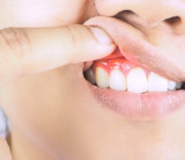 Man pushing up lip to show signs of gum disease in Waterbury, CT