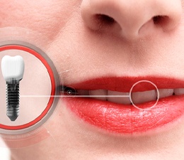 Image of dental implants in Waterbury.