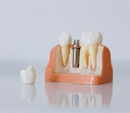 Model of dental implant parts