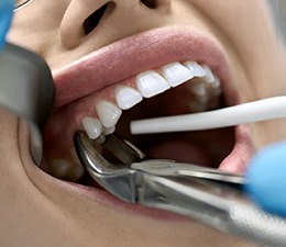 A patient receiving a tooth extraction