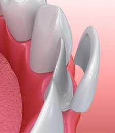 Digital model of porcelain veneer on lower tooth
