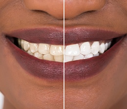 Patient's smile before and after teeth whitening