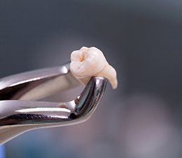 Dental forceps holding a tooth
