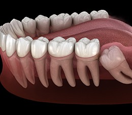 Digital illustration of impacted wisdom tooth