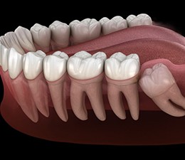 Illustration of impacted tooth