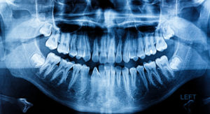 Your 06708 answers whether or not wisdom teeth should be removed.