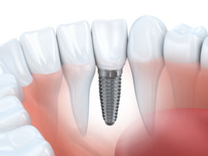 dental implants Waterbury