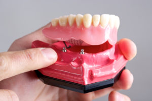 Your dentist explains the benefits of implant dentures in Waterbury