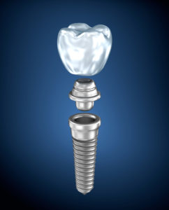 Your dentist for dental implants in Waterbury.