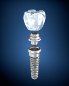Your dentist for dental implants in Waterbury.
