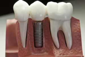 Model of dental implant