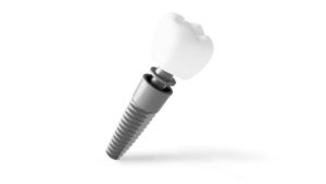 dental implant