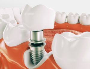 single tooth dental implant