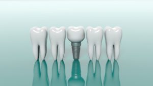 dental implant