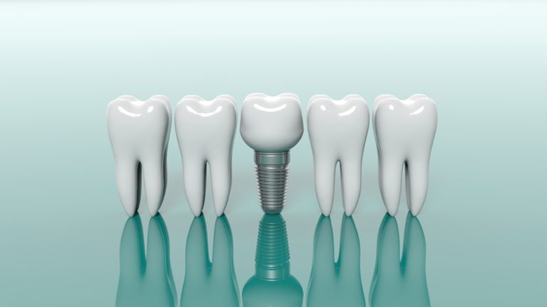 How to Find the Best Dental Implants in Waterbury