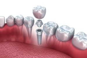 parts of a dental implant