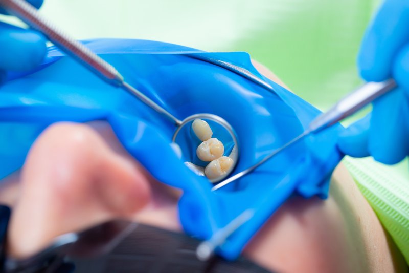 an up-close view of a dentist using a dental dam to perform a root canal