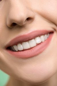 Woman with white spot needing teeth whitening in Waterbury