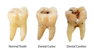 Model showing different stages of tooth decay